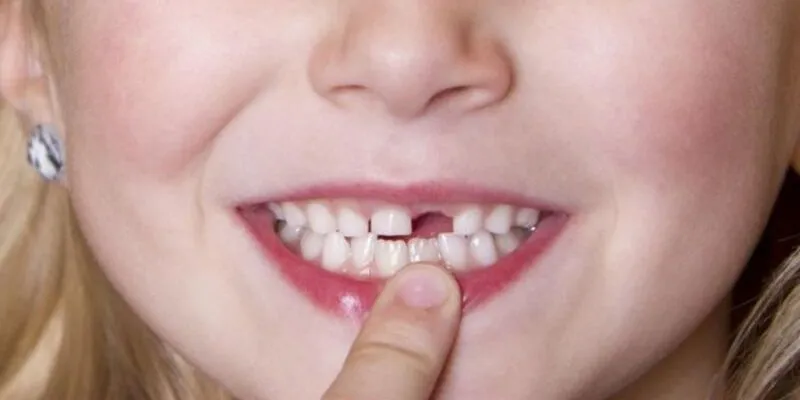 Con số may mắn khi nằm mơ rụng răng: Giải mã chi tiết 3 Tìm ý nghĩa khi mơ thấy rụng răng giả